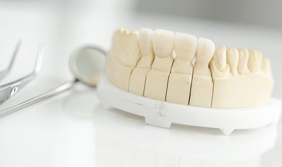 Modell einer Zahnbrücke
