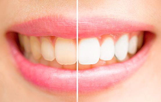 Zähne vor und nach dem Bleaching